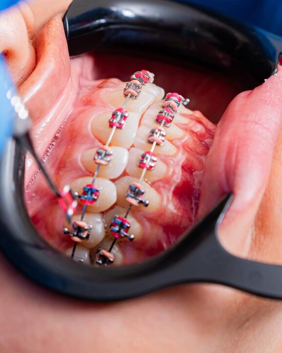 Orthodontic braces used to align teeth, correct bite problems, and enhance overall smile appearance.